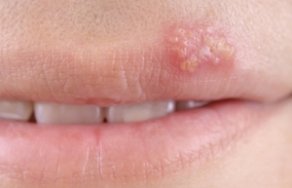 Герпес на губах — симптомы