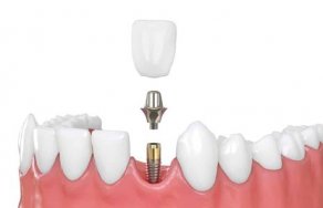 Что нужно знать о процедуре имплантации зубов