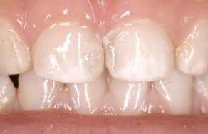 Серебрение и фторирование молочных зубов
