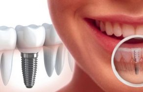 Преимущества зубных имплантов по сравнению с традиционными методами восстановления зубов