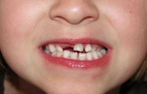 Что такое молочные зубы и зачем они нужны?