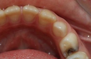 Лечение пульпита у детей: забота о здоровье детских зубов