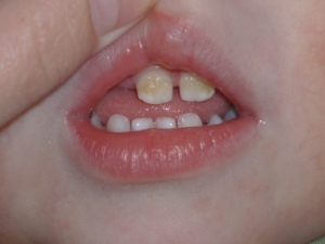 молочные зубы