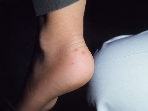 симптомы энтеровирусного стоматита - сыпь на ногах