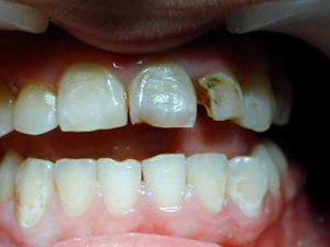 кариес переднего зуба