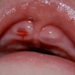 prorezivanie-zubov-u-detej-foto-desni-simptomi4